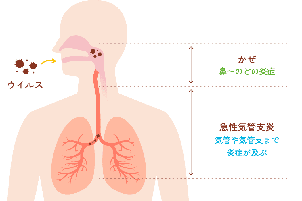 かぜ（鼻〜のどの炎症）・急性気管支炎（気管や気管支まで炎症が及ぶ）